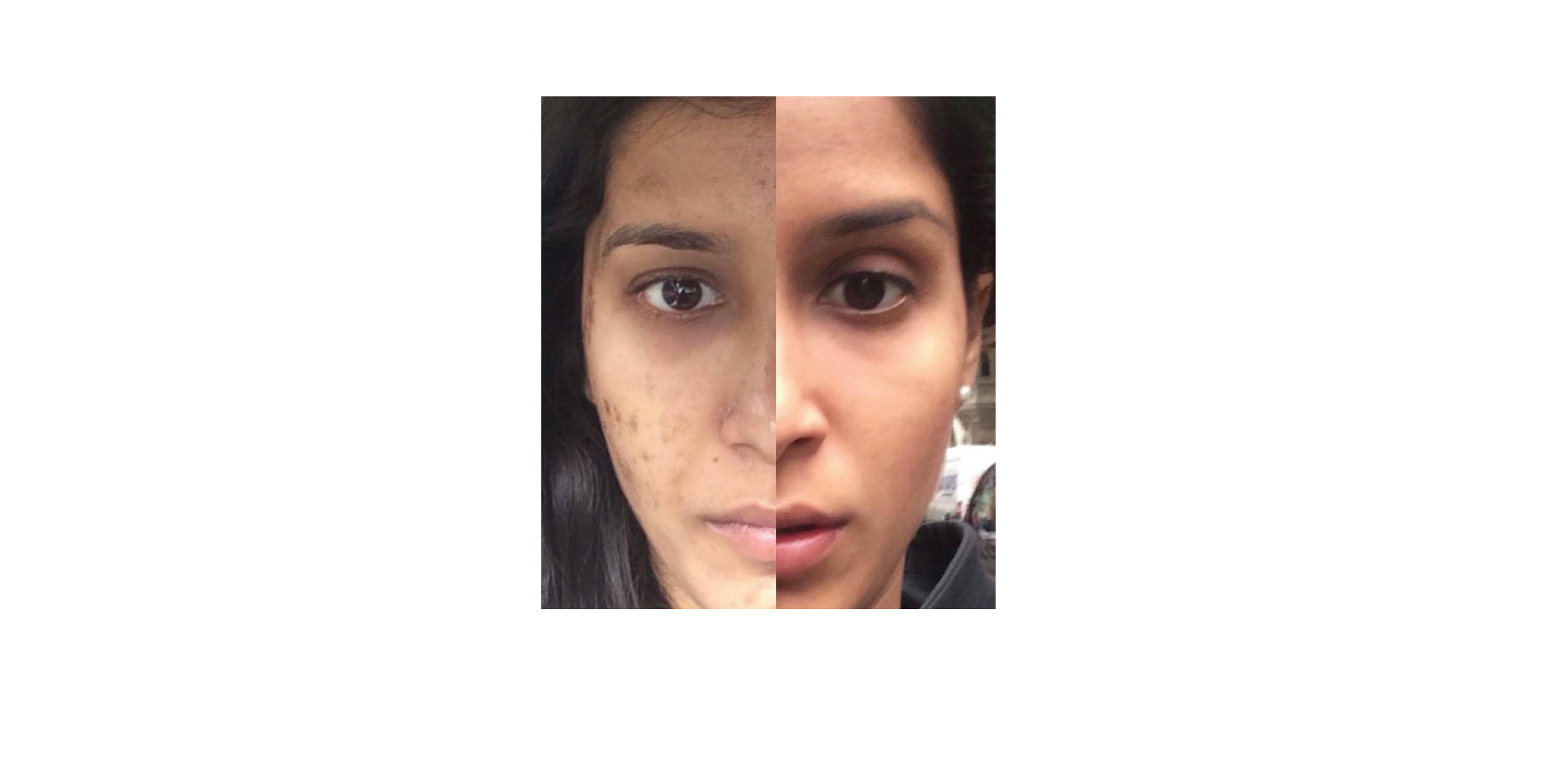 My journey with adult acne